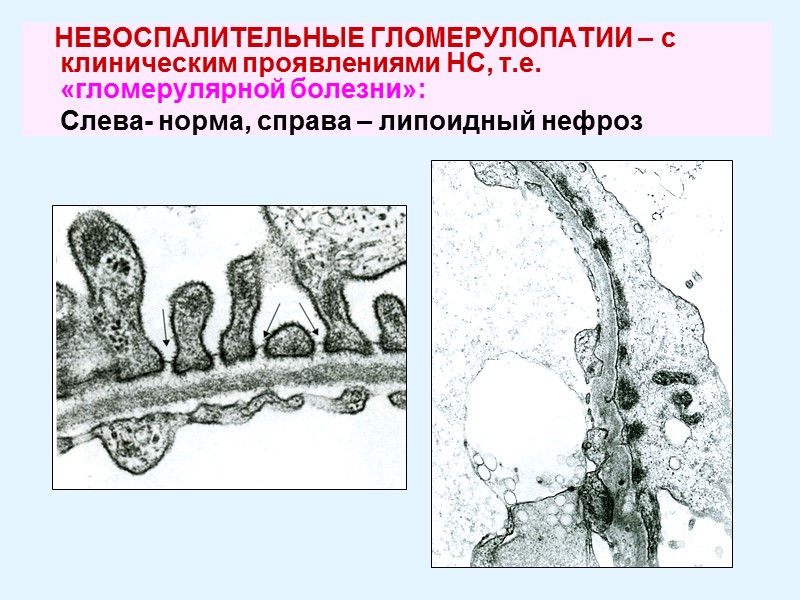НЕВОСПАЛИТЕЛЬНЫЕ ГЛОМЕРУЛОПАТИИ – с клиническим проявлениями НС, т.е.    «гломерулярной болезни»: 
